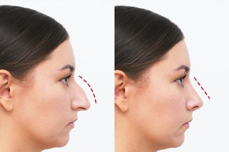 Before and After Results 2