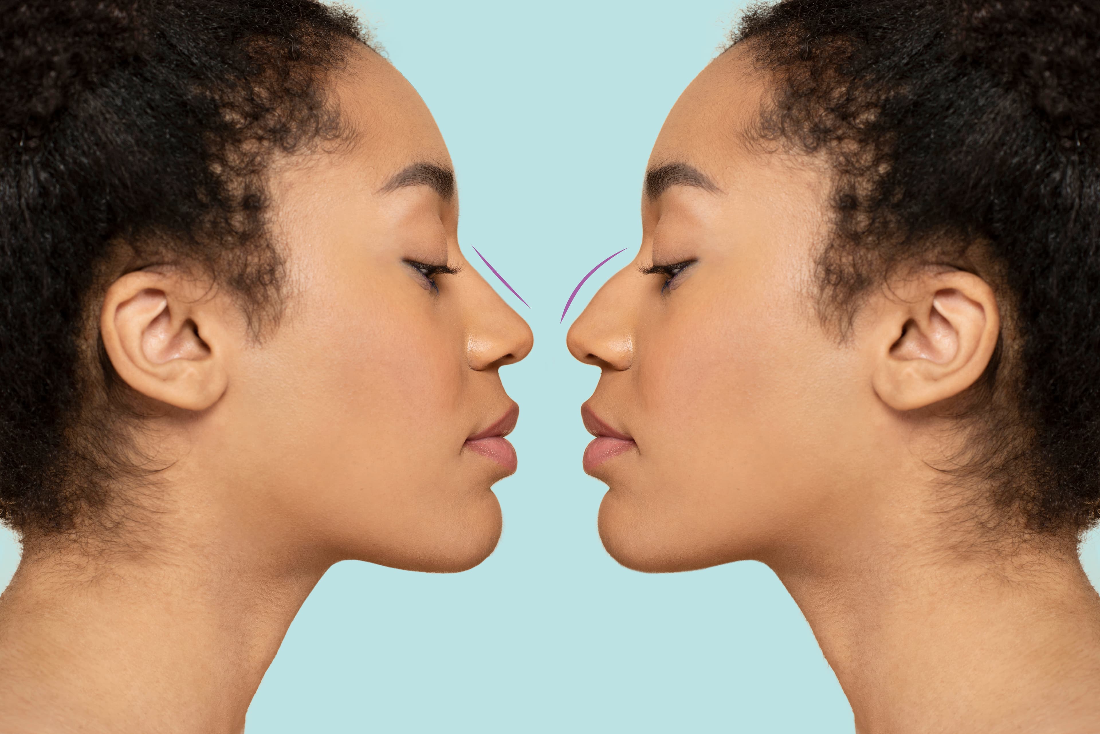 Rhinoplasty in Hyderabad: What to Expect Before, During and After Surgery | Personiks