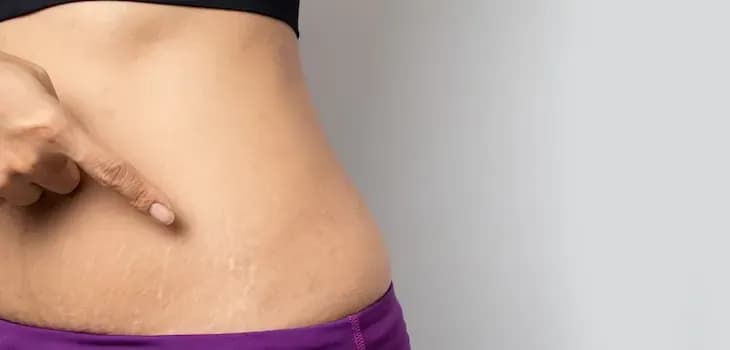 Stretch Marks Removal Treatment in Hyderabad | Laser, Microneedling & Realistic Results